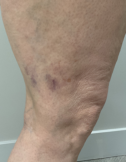 Spider Veins — Left Leg - After